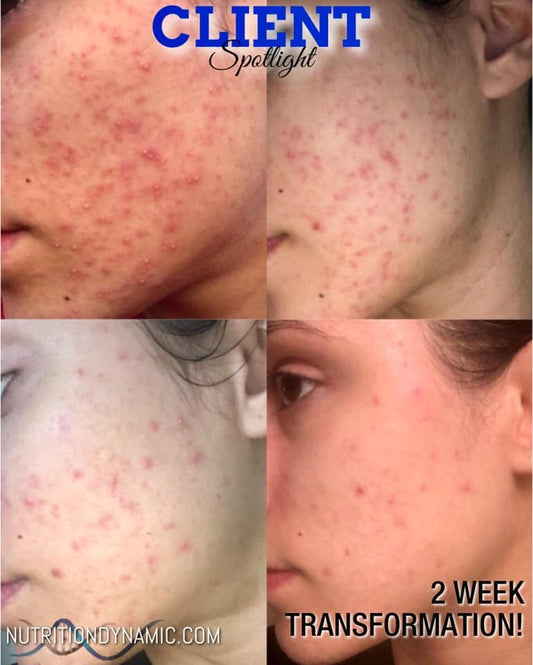 Curing Adult Acne After Antibiotics